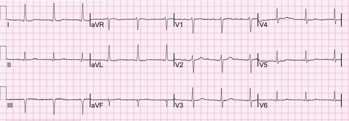 Is ECG on PulseNexa Watch Accurate?