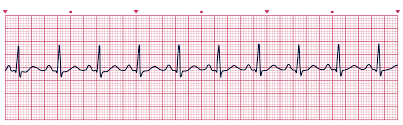 How Can ECG Monitoring Enhance Your Heart Health?