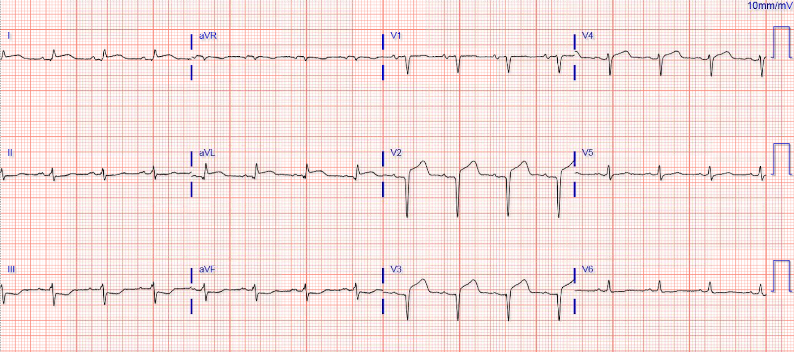 Are ECG Watches Accurate? Unveiling the Truth Behind Heart Monitoring Technology