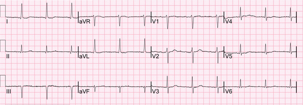 Is ECG on PulseNexa Watch Accurate?