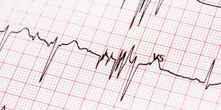 Understanding Atrial Fibrillation (AFib): A Comprehensive Guide